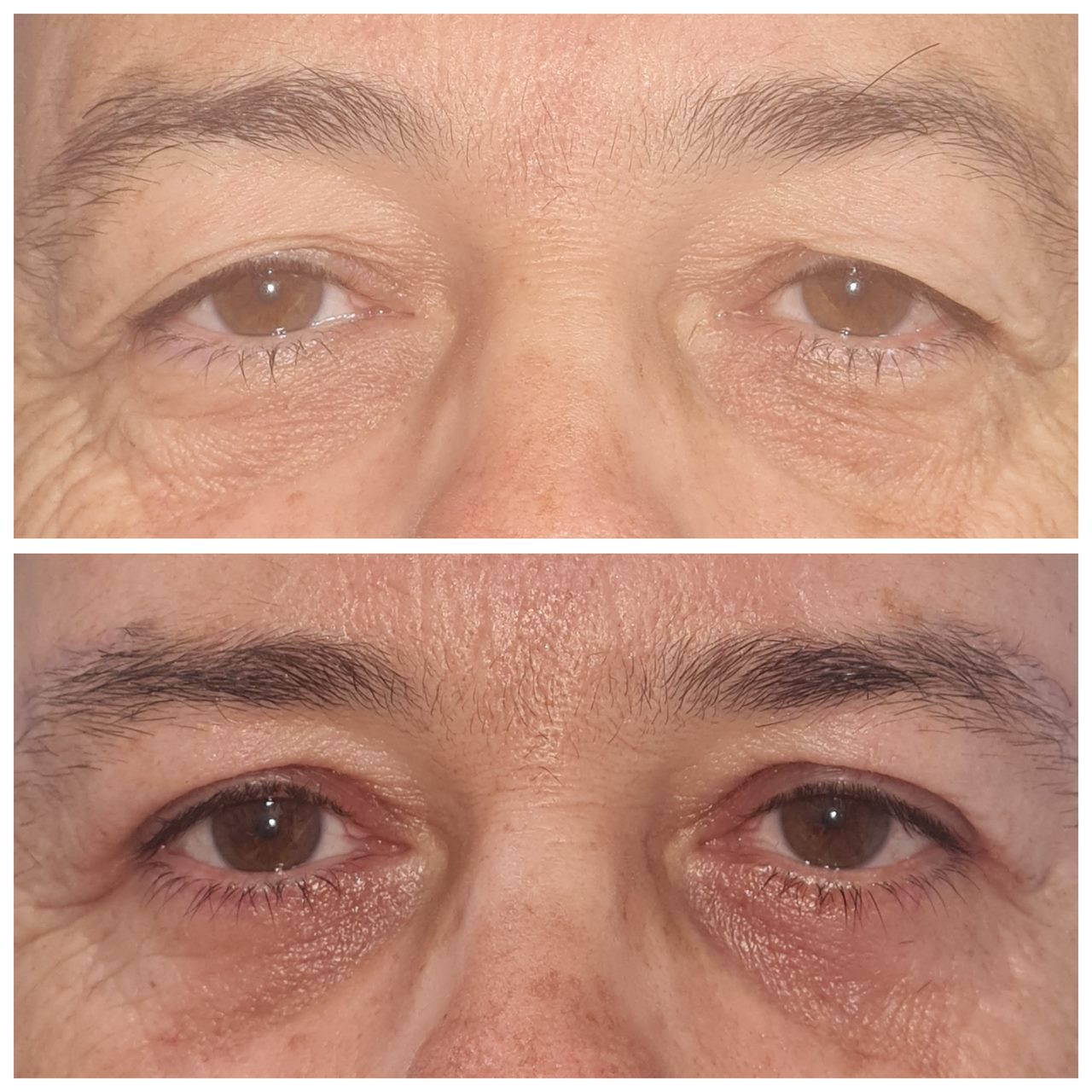 Antes e depois de blefaroplastia 5